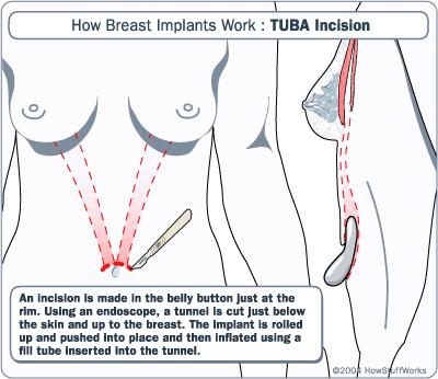 TUBA (trans-umbilical breast augmentation) or Periumbilical Is performed by inserting the implant through an incision in the umbilicus (navel) and moving it into place in the breast.