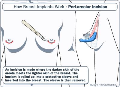 Periareolar Breast Augmentation Implants placed by an incision within the pigmented areolar tissue, referred to as a periareolar incision, often result in the least conspicuous scar.