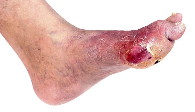 Diabetic/Neuropathic Ulcers A diabetic or Neuropathic ulcer is defined as an injury