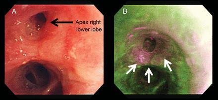 AutoFlorescence Bronchoscopy Based on difference in florescence between normal and neoplastic epithelium
