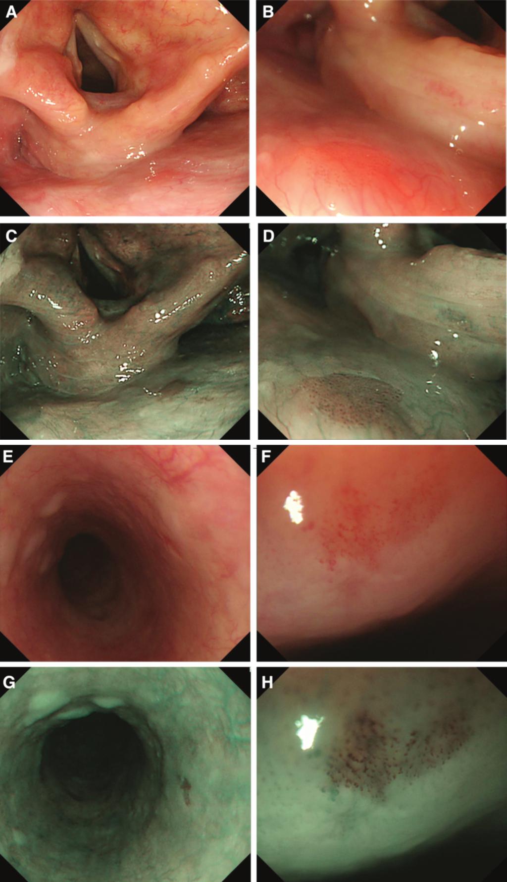 Muto et al Endoscopic Evaluation of Superficial Cancers In this study, the real-time on-site diagnosis was evaluated because making an accurate diagnosis during an examination is clinically more