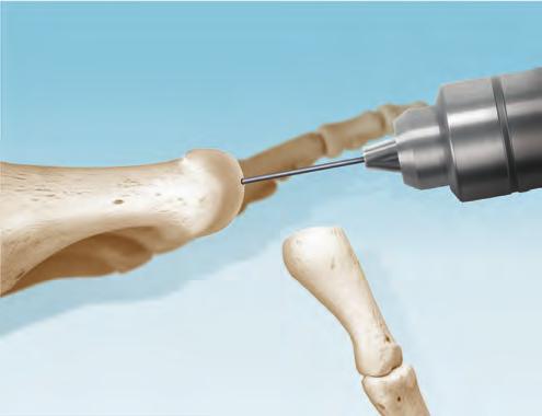 MTP SURGICAL TECHNIQUE* CoLink XP Plates COMPRESSION PLATING SYSTEM INCISION/EXPOSURE A dorsal longitudinal incision is commonly used. This approach provides excellent exposure of the MTP joint.