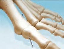 PHALANGEAL PREPARATION The proximal phalanx is plantar flexed using a retractor of choice. The 1.