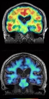 Amyloid and tau detection with PET scans 20 yrs pre symptoms