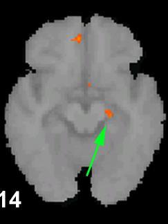 Imaging brain circuit function Resting state fmri