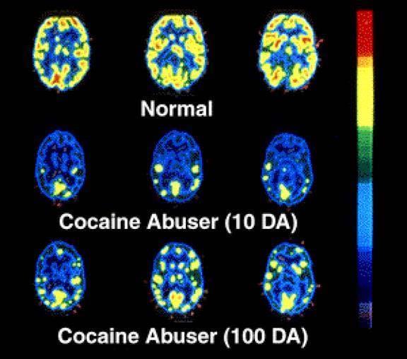 Organ Brain Impairment Changes in Addiction Normal levels of brain activity in PET scans show in yellow & red Reduced brain activity after regular use is still seen after 10 days