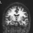 MRI: Hippocampal Size