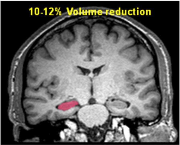 Fig. 1. Average reduction in hippocampal volumes found amongst heavy, long-termadult cannabis users.