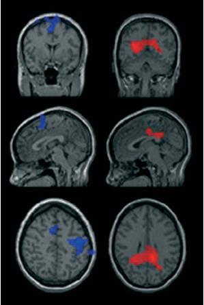 Sex differences in cocaine abusers: SPECT imaging Men Women Cocaine-dependent men: Decreased perfusion in the precentral gyrus, superior and medial frontal gyri, and the anterior cingulate cortex,