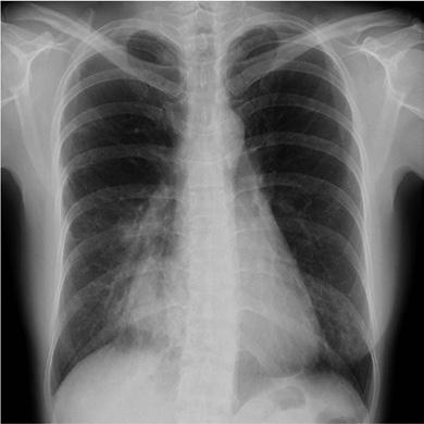 Answer 2 The chest radiograph showed alveolar opacities in the right lower and middle lobes and in the left lower lobe. There were also nonsystematised opacities in the right upper lobe.