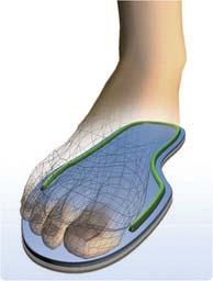 SoleSensor (TM) Toronto Rehab scientists have developed a simple