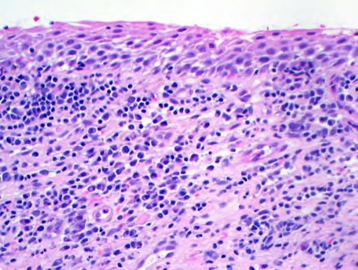 Histologic Features Atrophic epidermis Spongiosis Loss of stratum corneum Prominent