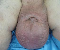 DDx: Localized Lymphedema Reactive, pseudotumor/pseudosarcoma