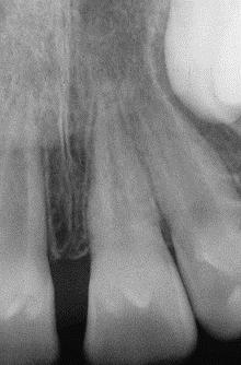 Dental Trauma Continued Root