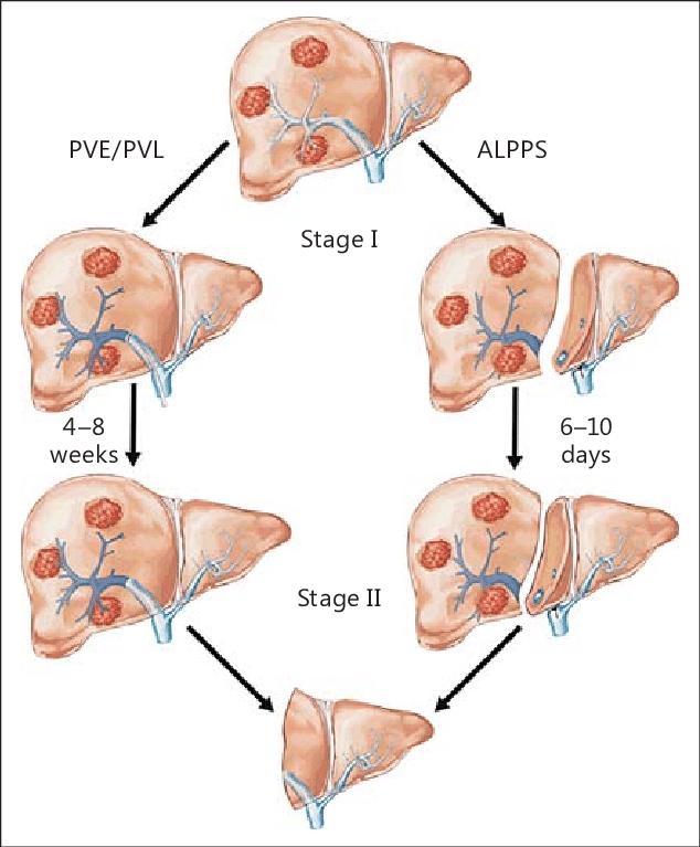 ALPSS Associating liver partition and portal vein ligation for staged hepatectomy LIGRO RCT from Sweden of 97 patients with bilobar CLM ALPPS resection rate 92%