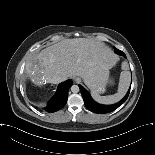 Recurrent CLM 40% of patient will recur after resection of CLM Recurrence can be: at margin, hepatic, or extrahepatic