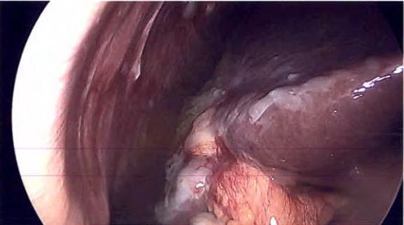Objectives Surgical management of solitary and oligo-metastatic colorectal cancer (liver, lung,