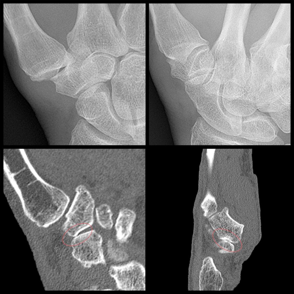 Fig. 1: Example of a patient in which STT OA was not detected with radiography. The scaphoid-trapezium joint space seem normals on the radiographs.