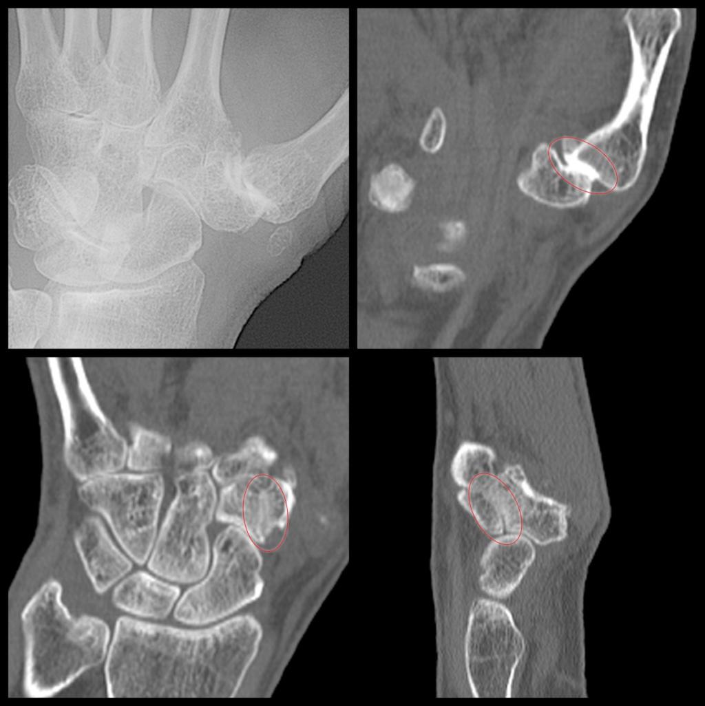 Fig. 2: Example of a patient with CMC1 OA in which STT OA was only detected with CT and not with radiography.