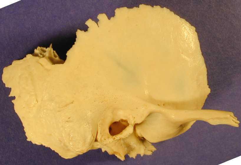 SUPERIOR Temporal Bone, Lateral view POSTERIOR Squamous portion ANTERIOR Supramastoid crest Suprameatal crest External
