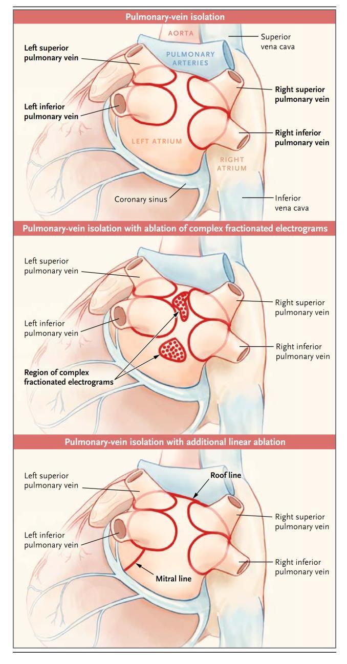 Approaches to Catheter Ablation for