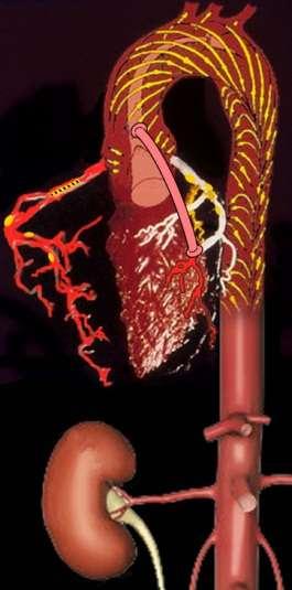 CAD: The Role of the Aorta and the Kidneys Stiff aorta: Myocardial perfusion, MVO 2 Chest pain of aortic origin