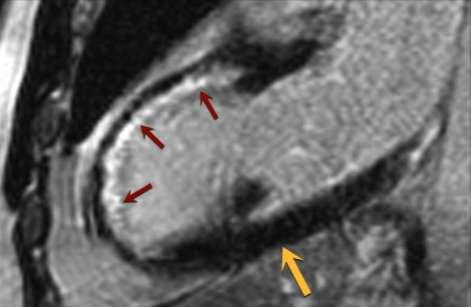 CAD: Viable Myocardium MRI PET Dobutamine echo Thallium Other Bonow R et al.