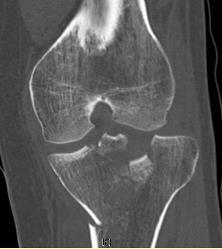 Graftys Quickset & Graftys HBS use in plateau tibial fracture Introduction& Patient Profile 35 years-old women A complex plateau tibial fracture Pre-operative Scan & Radiography