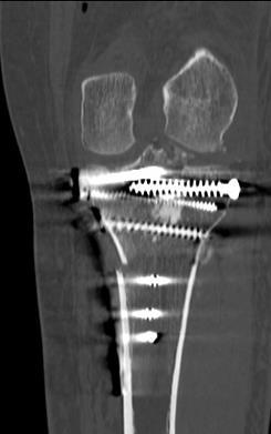X- Ray Immediate postoperative Scan