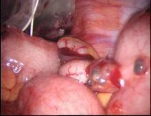 8% - excision of endometriotic