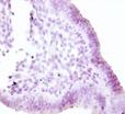 Immunohistochemical analysis Immunohistochemical study of 49 patients with endometriosis and 18 healthy women of comparison group was performed.