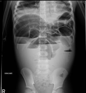 Toddler with Vomiting, Abdominal Distension and Bruising Patent airway,