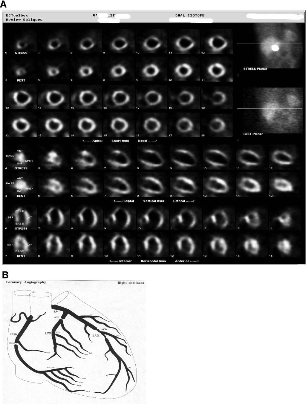 58 J.H. Mieres, D.R. Rosman, and L.J. Shaw Figure 6 (A) Case of a 66-year-old diabetic man with a history of an enlarged heart and no history of myocardial infarction who was admitted to the hospital