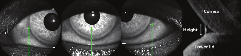 Korean J Ophthalmol Vol.32, No.5, 218 A B C D Fig. 1. Lower eyelid tear meniscus height was measured by anterior segment optical coherence tomography with a Spectralis optical coherence tomography.