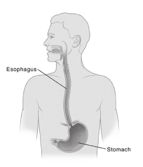 Esophageal cancer What is esophageal cancer? What are risk factors? Signs and symptoms Tests for esophageal cancer Stages of esophageal cancer Treatment options What is esophageal cancer?