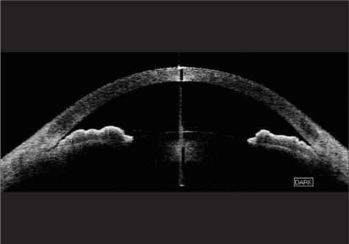 Figure 2b Anterior segment optical coherence tomography images of