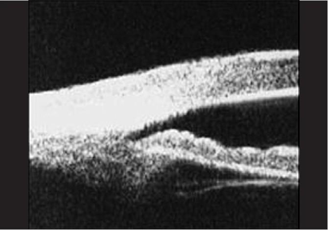 Figure 3 Ultrasound biomicroscopy image