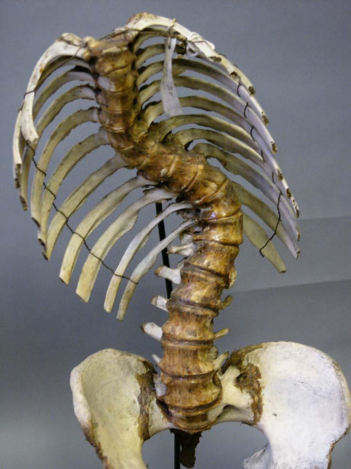 Asymmetries in Thorax - ribs Spine - vertebrae pelvis 11 th International Conference on