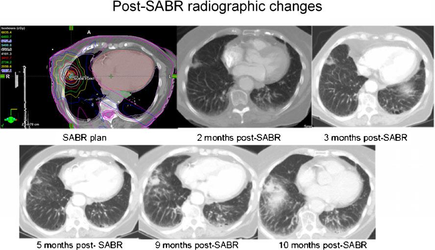 J Radiat Oncol (2012) 1:11 16 13 where 50 patients with stage I NSCLC were treated with SABR to a dose of 50 Gy in 5 fractions, only 3 of 20 patients who had abnormal opacity were eventually found to
