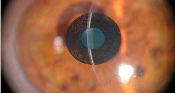 near vision by extending depth-of-focus Central aperture is a hole in the inlay and has no power Inlay