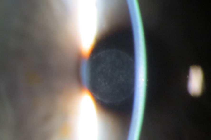 eye, Artificial tear use Visual improvement 1-3 months Post-op drop regimen-3 months