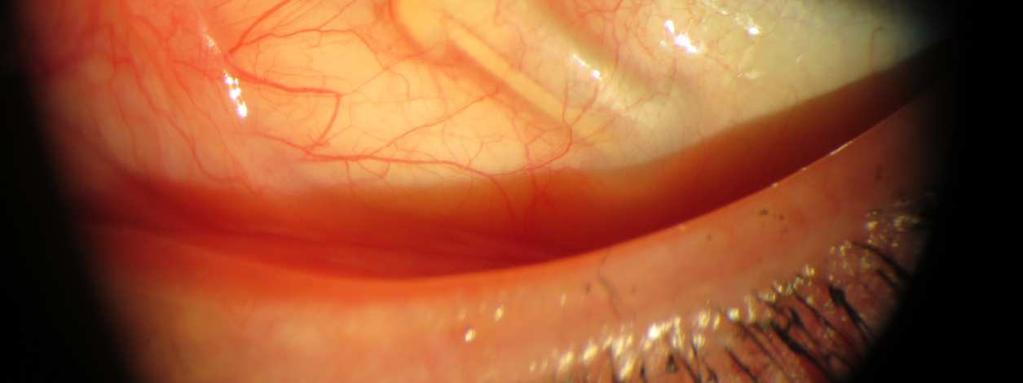 Sources: Questions Review of Ophthalmology September 2014 Raindrop Near Vision Inlay OD guide Cataract and Refractive Surgery Today, Vol.15, No.