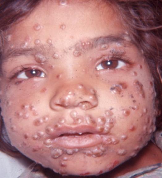 Vaccines are often victims of its success Small pox in