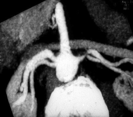 renal artery stenoses due to atheroma or fibromuscular