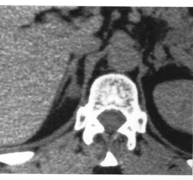 La découverte d anomalies morphologiques TDM surrénaliennes Abdominal CT scan : adrenal morphological abnormalities