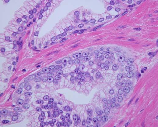 Prostate Carcinoma by H&E 35 35