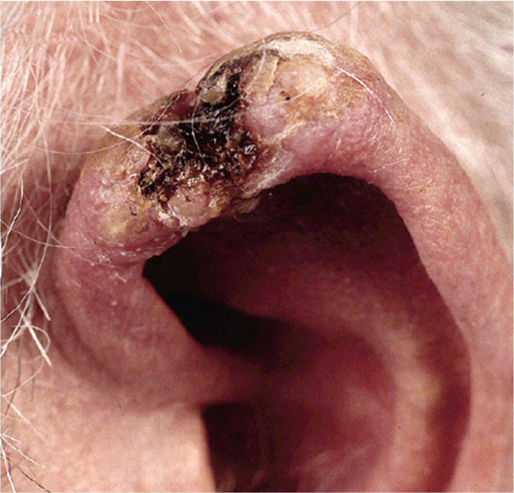 SCC: Or a non-healing lesion on the