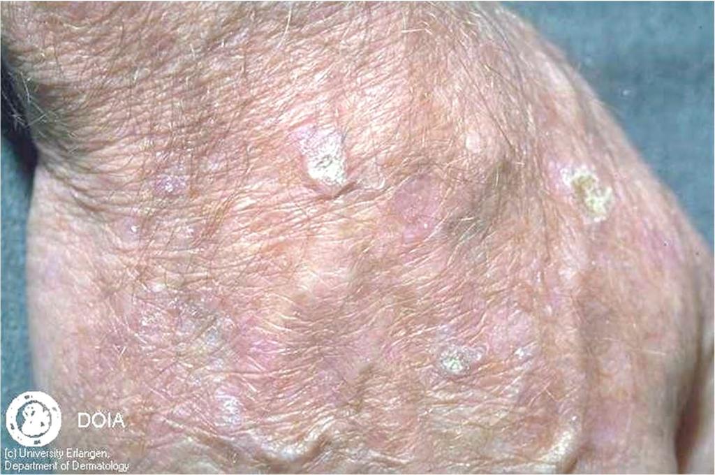 What are actinic keratosis or