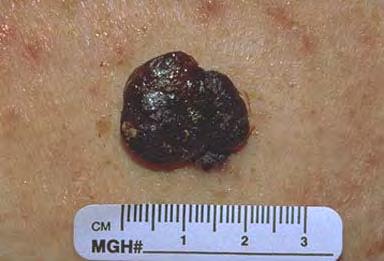 Nodular melanoma Most common on legs and trunk Can rapidly grow