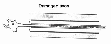 Page 4 In a moderate injury, the nerve fiber (axon) is damaged and cannot transmit steady electrical signals. The cellular structure around the nerve is not injured.